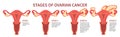 Four stages of ovarian cancer isolated white