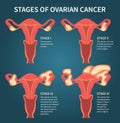 Stages of womans ovarian cancer dark blue scheme
