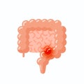 Flat vector illustration of sick human intestine