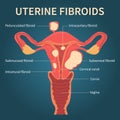 Uterine fibroids close-up view on dark blue Royalty Free Stock Photo