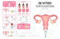 Flat In Vitro Fertilization Infographic Concept