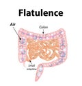 Flatulence. Gases in the small intestine. The gases in the colon.