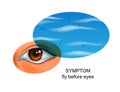 Flies before eyes. symptom of eye diseases