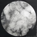 Fluoroscopic X-ray of the small intestine