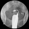 fluoroscopic X-ray study of a woman`s uterus and fallopian tubes