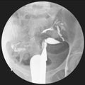 a fluoroscopic X-ray study of a woman`s uterus and fallopian tubes