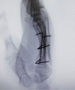 Fluoroscopic xray image fracture finger index exam Royalty Free Stock Photo