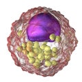 Foam cell, macrophage cells that contain lipid droplets