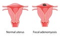 Focal Adenomyosis Human anatomy Female reproductive system diagram with text Sick and normal organ uterus vagina icon