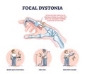 Focal dystonia as anatomical neurological muscle disorder outline diagram