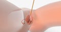 A foley catheter is a medical device that removes urine from the body