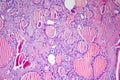 Follicular adenoma of thyroid gland