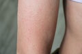 Follicular hyperkeratosis is located on the person`s arm Royalty Free Stock Photo