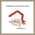 Follicular ovarian cyst. Functional cyst. Infographics.