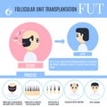 Follicular unit transplantation infographics for male alopecia t Royalty Free Stock Photo