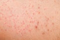 Folliculitis on female skin