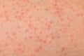 Folliculitis on female skin