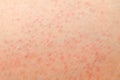 Folliculitis on female skin