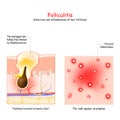 Folliculitis is infection and inflammation of hair follicles