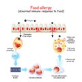 Food allergy. abnormal immune response to food