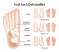 Foot anatomy scheme. Hollow and flat arch deformities. Diagram of normal