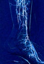 Foot angiorgam or Plantar angiogram angiogram showing Plantar and Tarsal Artery at foot area