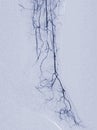 Foot angiorgam or Plantar angiogram angiogram showing Plantar and Tarsal Artery at foot area