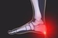 Foot and ankle pain, 3D illustration