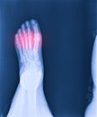 Foot and ankle pain on x-ray, isolated on black background Royalty Free Stock Photo