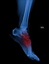 Foot and ankle pain on x-ray, isolated on black background Royalty Free Stock Photo