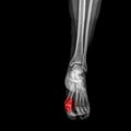 Foot and ankle pain on x-ray, isolated on black background Royalty Free Stock Photo