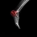 Foot and ankle pain on x-ray, isolated on black background Royalty Free Stock Photo