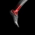 Foot and ankle pain on x-ray, isolated on black background Royalty Free Stock Photo