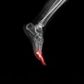 Foot and ankle pain on x-ray, isolated on black background Royalty Free Stock Photo