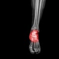 Foot and ankle pain on x-ray, isolated on black background Royalty Free Stock Photo