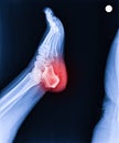 Foot and ankle pain on x-ray, isolated on black background, heel pain, heel spur Royalty Free Stock Photo