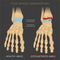 Foot arthritis image Royalty Free Stock Photo