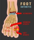 Foot arthritis infographic Royalty Free Stock Photo