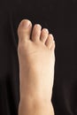 Foot on a black background with seronegative rheumatoid arthritis