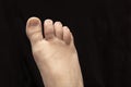 Foot on a black background with seronegative rheumatoid arthritis