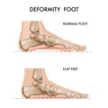 Foot Bones Deformation Composition