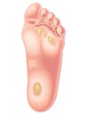 Foot calluses