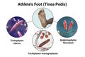 The foot with mycosis, and close-up view of fungi that cause Athlete's foot, 3d illustration