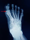 foot fracture proximal phalang