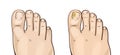 Foot fungal infections. Athlete`s foot is a fungal infection