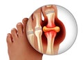 Foot Gout Anatomy