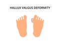 Foot with hallux valgus deformity