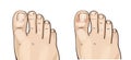 Foot herpes infections, medical illustration