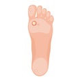 Foot impact point callus