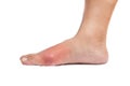 Foot with inflamed gout